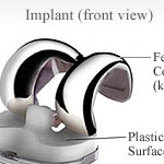 implant