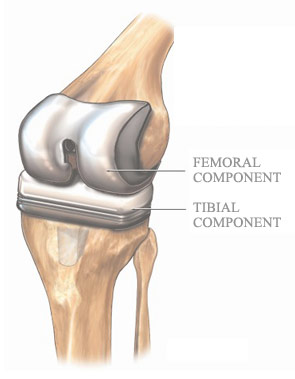Knee Replacement Costs