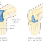 Thumbnail image for Partial Vs. Total Knee Replacement